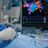 Pulsed field ablasyon (PFA) işleminde ablasyon kateteri ve arkada kalbin üç boyutlu haritası (temsili görsel)